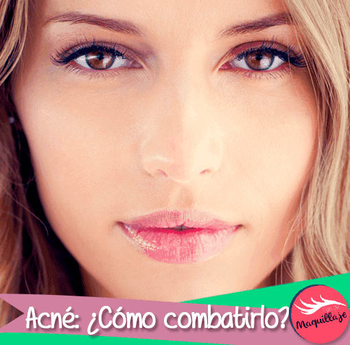 Acné: Zonas problemáticas